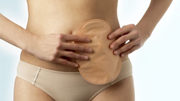 Why do I need to wear an ostomy pouch? 