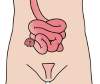Ileostomy Ileostomy