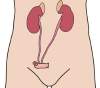Urostomy Urostomy